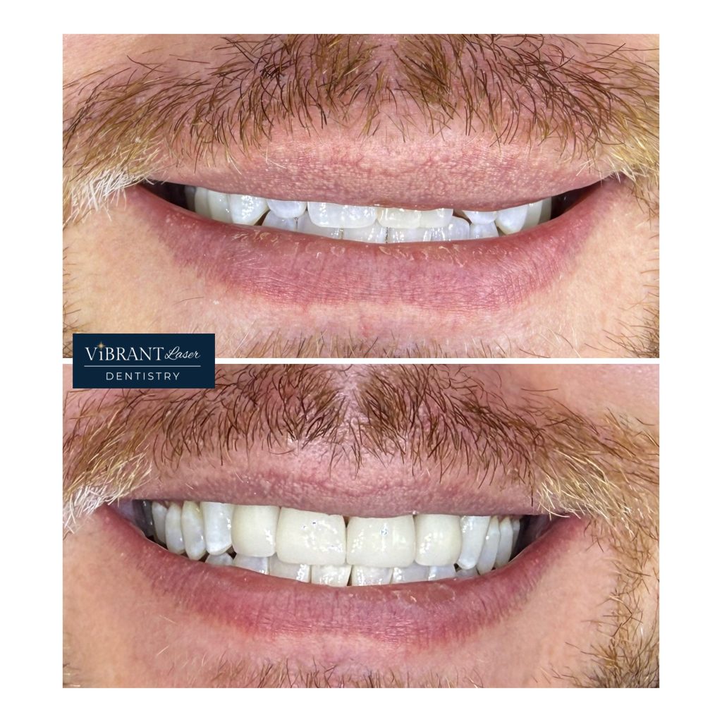 Before and after images of a man's smile showcasing teeth whitening results from Vibrant Laser Dentistry.