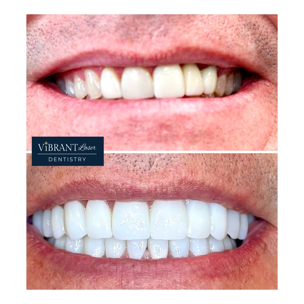 A side-by-side comparison of a person's teeth before and after a cosmetic dental treatment, showcasing a significant improvement in brightness and