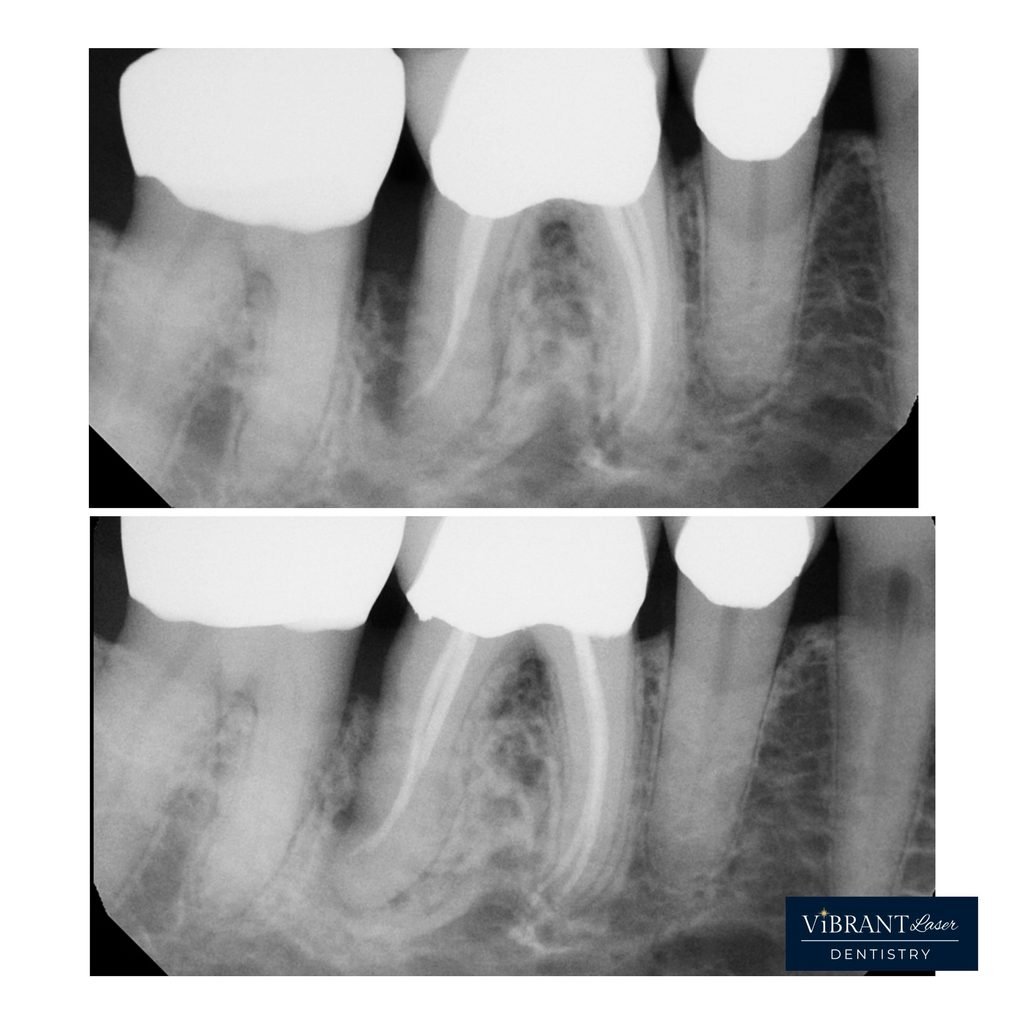 Dental X-rays showing two rows of teeth with root structures, labeled for diagnostic purposes at Vibrant Laser Dentistry.