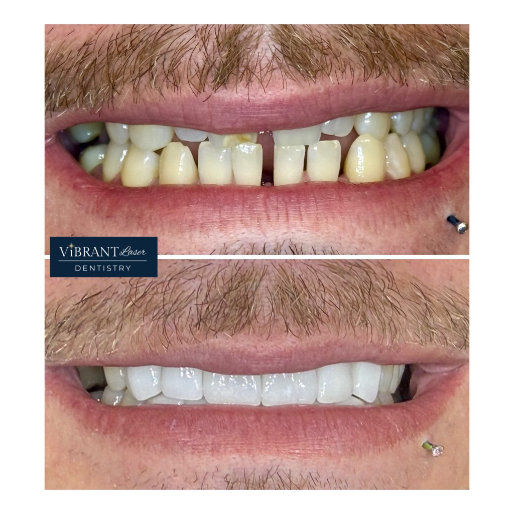Before and after images of a man's teeth, showing a gap and discoloration in the top image, with a straight, whiter appearance in the bottom.