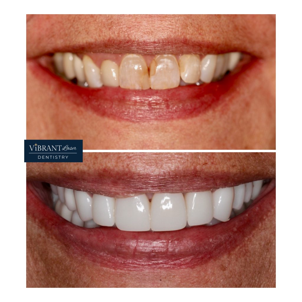 A before-and-after comparison of a smile showing stained teeth at the top and a bright, even white smile at the bottom.